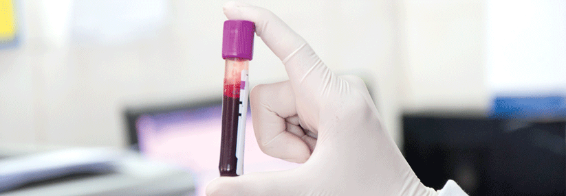 Labordiagnostik: HDL ist Pflicht, Lp(a) überflüssig Nicht jeder „kardiologische“ Blutparameter hat tatsächlich Aussagekraft.