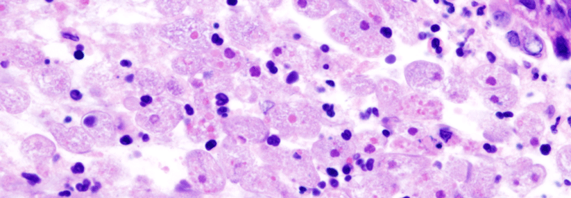 Das primär den Dickdarm besiedelnde Protozoon Entamoeba histolytica verursacht in 90 % der Fälle keine Beschwerden.