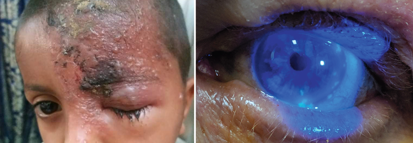 Die Infektion macht sich ebenfalls auf der umliegenden Haut bemerkbar (links). Mit einer Fluoreszenzfärbung kann man die Viren jedoch auch im Auge sichtbar machen (rechts).