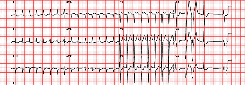 Während einer typischen AV-Knoten-Reentry-Tachykardie kommt die P-Welle am Ende des QRS-Komplexes.