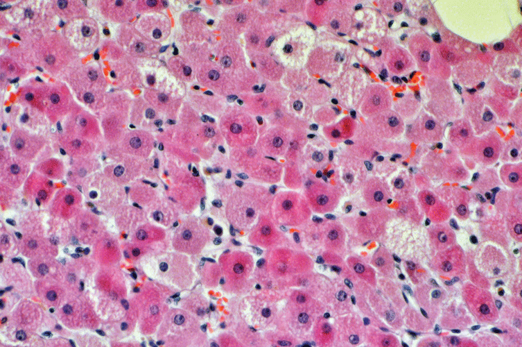 Die großen polygonalen Zellen mit stark eosinophilem Zytoplasma, großem Kern und prominentem Nukleolus sowie einzelnen Spiderzellen wiesen auf das Rhabdomyom hin.