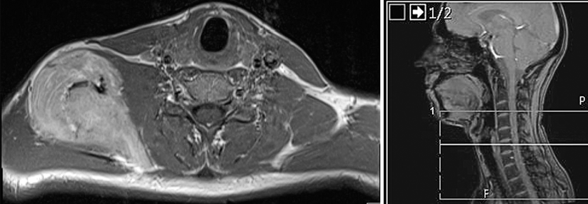 Im MRT maß der Tumor am rechten lateralen Halsdreieck 8,5 x 5,3 cm.