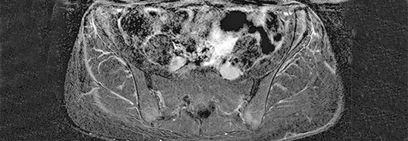 Das MRT des Beckens zeigt die Entzündung an den Sehnenansätzen des Os ilium auf beiden Seiten sowie ein Knochenödem im rechten Hüftkopf.  