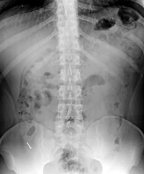 Bei einer Röntgenuntersuchung im Rahmen einer Routinediagnostik entdeckten die Kollegen aus Ecuador einen metallischen Fremdkörper im unteren rechten Abdomen.