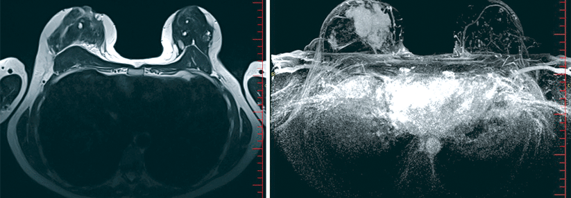 Links: Die MRT-Aufnahmen in der T2w-Sequenz bestätigen die hohe Dichte des Drüsenparenchyms (ACR 4). Außerdem finden sich rechts axillär zwei auffällige Lymphknoten (aufgehobene Hilusarchitektur). Rechts: Die mittels Maximumintensitätsprojektion bearbeiteten Bilder der Kontrastmittel-Funktionsaufnahmen ergeben rechts eine Tumorausdehnung von fast 10 cm.