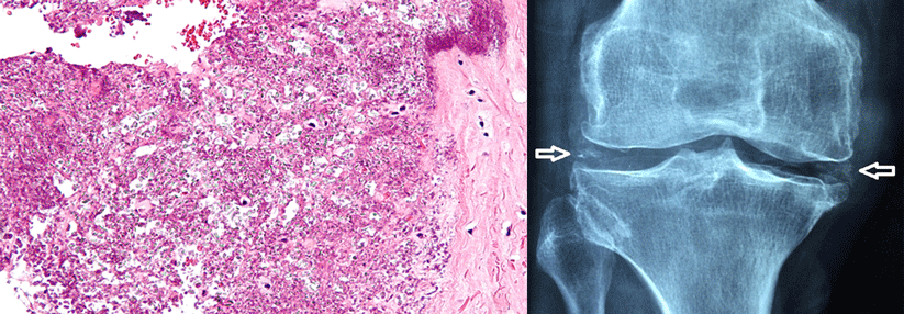 Links: In die Bandscheibe verkriechen sich die Kristalle aus Kalziumpyrophosphat-Dihydrat auch gerne. Rechts: Typisch für die Calciumpyrophosphat-
Dihydrat-Arthropathie sind kalkdichte Ablagerungen in den Menisken (Pfeile).