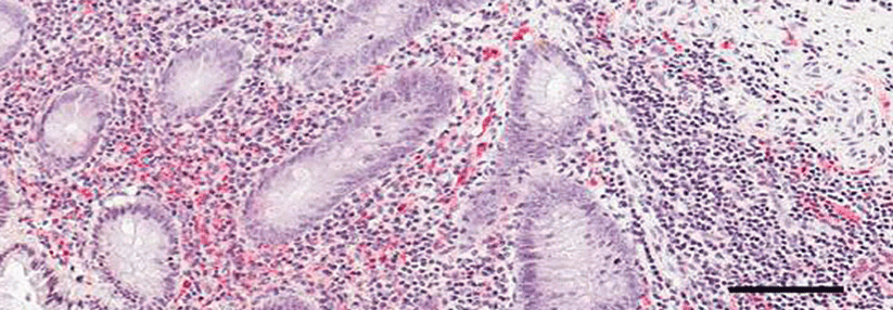 Die histologische Färbung der Appendix eines gesunden Patienten zeigt ein hohes Proteinase-K-resistentes alpha-Synuclein-Vorkommen (rot) der Mucosa. Eine Balkenlänge entspricht 100 μm.