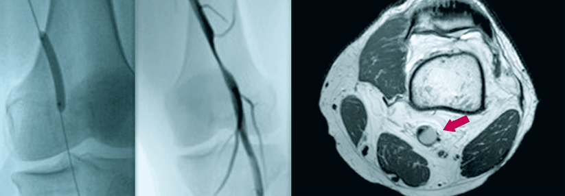 Sogar nach der Dilatation (links) bleibt die hochgradige Stenose der A. poplitea hartnäckig bestehen (mitte). Im MRT zeigt sich eine gefäßkomprimierende 8 x 37 mm große Zyste (rechts).