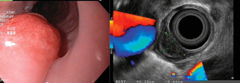 Die Ausdehung des endoskopisch entdeckten Plattenepithelkarzinoms lässt sich mithilfe des endoskopischen Utraschalls gut ermitteln.