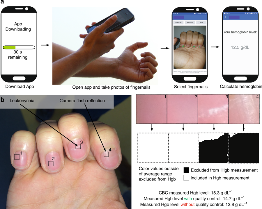Die App erkennt eine Anämie anhand von Fotos der Fingernägel.