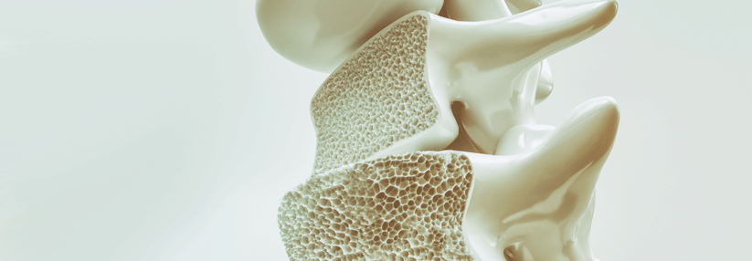 Die malignen Plasmazellen im Knochenmark können u.a. zu Knochenläsionen und Osteoporose führen.