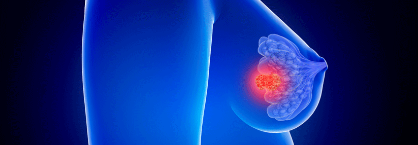 HER2-heterogene Mammakarzinome machen offenbar eine besondere Subgruppe aus, der auch eine auf sie ausgerichtete Therapie zugutekommen sollte.