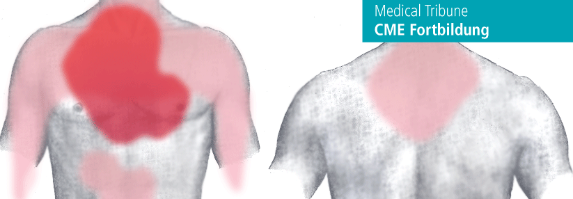 Handelt es sich um eine Angina pectoris, treten die Schmerzen besonders stark im Brustbereich auf, können aber auch weiter ausstrahlen.