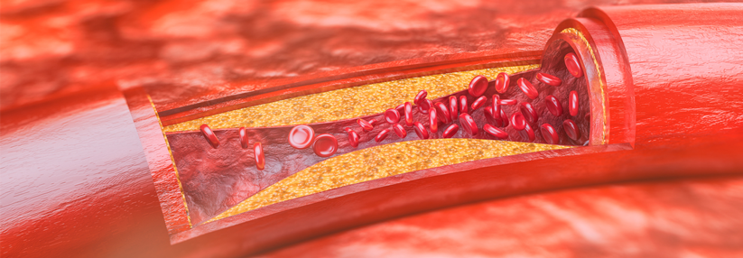 Das Risiko für kardiovaskuläre Ereignisse wie Atherosklerosen sinkt bei Diabetespatienten durch Liraglutid.