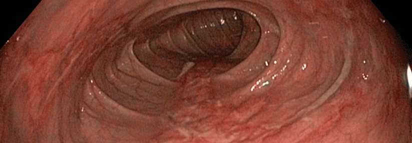 Sind keine schwarzen, nekrotischen Areale vorhanden, ist eine ischämische Colitis noch reversibel.