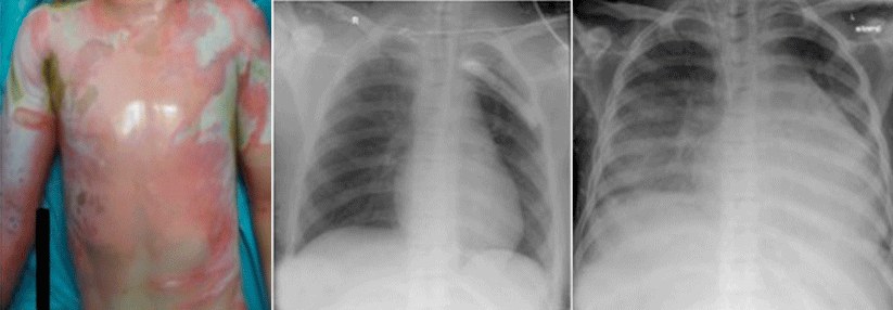 Der 12-Jährige erlitt schwere Verbrennungen an 70 % der Körperoberfläche (links). Innerhalb von zehn Wochen vergrößerte sich der Herz-Lungen-Quotient von 0,50 (Mitte) auf 0,63 (rechts).