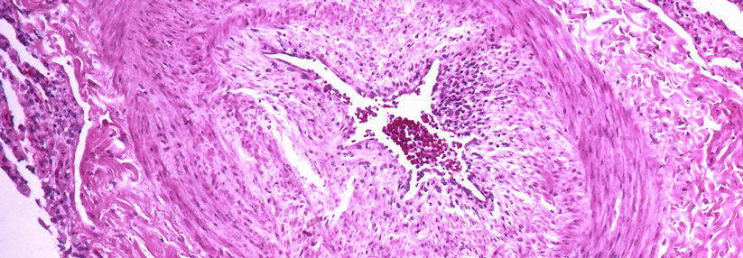 Der bisherige Grenzwert zur pulmonalen Hypertonie könnte sich ändern.