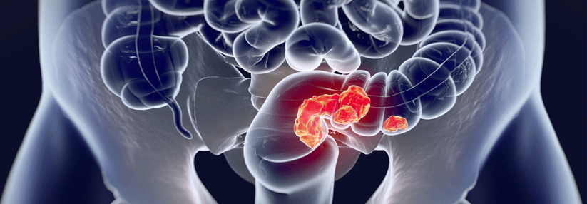 Bisher war der Einsatz von Checkpoint- Inhibitoren beim mCRC nur in einer Subgruppe erfolgreich.