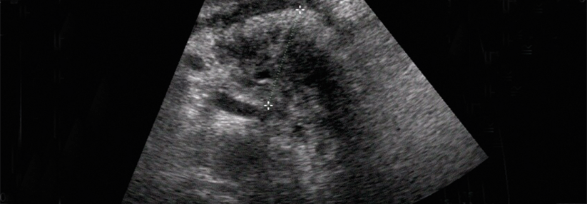 Schmerzen erschweren oft die Sonographie einer akuten Pankreatitis. Suchen Sie deshalb nach Leitstrukturen. 