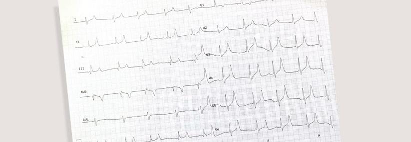 Typisches Anzeichen für eine Hyperkaliämie: erhöhte T-Wellen im EKG.