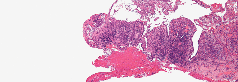 Beim Pemphigus vulgaris sammelt sich zwischen den Keratinozyten und der Basalmembran Flüssigkeit, sodass Blasen entstehen. Diese platzen und die Erosionen verkrusten.