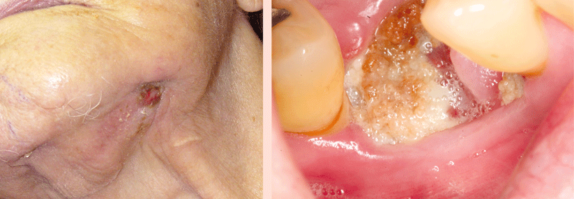 Bisphosphonatassoziierte Osteonekrose im Unter- (links) und Oberkiefer (rechts). Bei der Patientin (links) hat sich bereits eine extraorale Fistel gebildet.