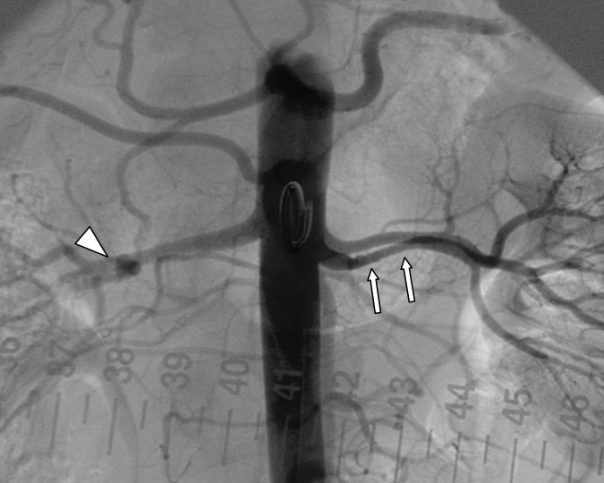 Angiografie einer Nierenarterienstenose aufgrund einer fibromuskulären Dysplasie