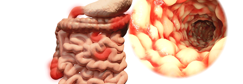 Immer mehr Menschen leiden unter chronisch-entzündlichen Darmerkrankungen wie Morbus Crohn.