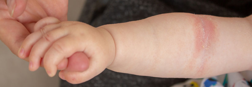 Wenn die Kinder Neurodermitis haben, belastet dies auch die Eltern.