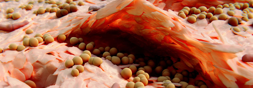 Neurodermitis kann sich auf diverse Organe auswirken Patienten mit Neurodermitis haben nicht nur ein erhöhtes Risiko für Staphylococcus-aureus-Infektionen.
