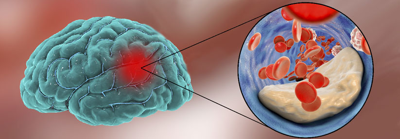 Unabhängig davon, wie viele kleine Lecks die Hirngefäße aufweisen, ist das Risiko für einen weiteren Verschluss immer größer als für eine Blutung.