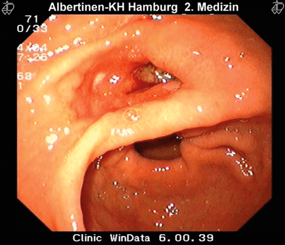 Hier hat sich das Geschwür schon bis in den Zwölffingerdarm durchgearbeitet.