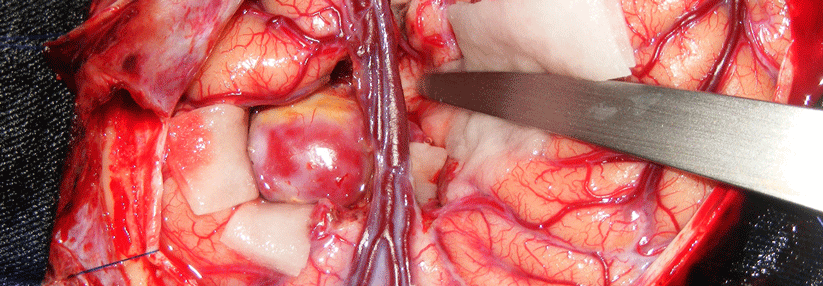 Subarachnoidalblutungen werden in den meisten Fällen durch Aneurysmen ausgelöst.