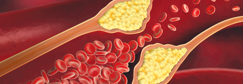 LDL ist kausal mit der Entwicklung der Atherosklerose verknüpft.