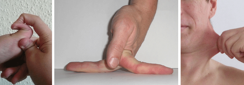 Typisch für das Ehlers-Danlos-Syndrom sind überstreckbare Gelenke und eine überdehnbare Haut.