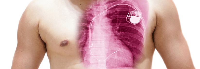 Ein implantierter Defibrillator kann mehr Leben retten als Antiarrhythmika.