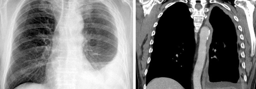 Das Röntgenbild (links) und das CT-Bild (rechts) sollten einen Verdacht auslösen. Die Pleura ist verdickt und es gibt einen Erguss.