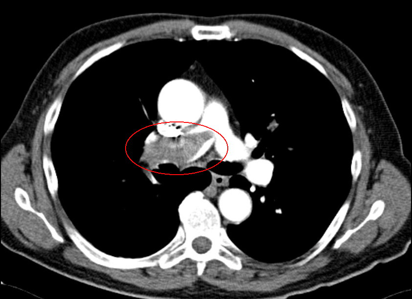 Lungenembolie mit Nachweis eines großen Thrombus innerhalb der rechten Pulmonalarterie.