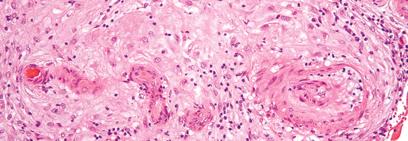 Histologisches Korrelat eines Bluthochdrucks in der Schwangerschaft: Hypertrophe Vaskulopathie im Endometrium.