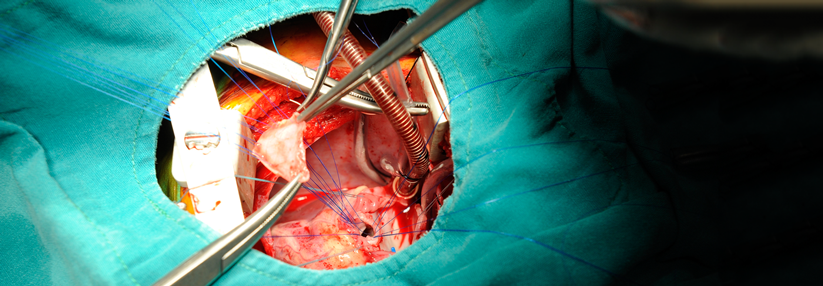Ob TAVI oder offene Operation: Jeder Zweite entwickelt nach dem Eingriff eine Herzrhythmusstörung.