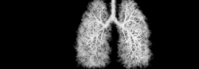 Wenn die Suche nach einer möglichen COPD beginnt, kann auch gleich noch nach einer Krebserkrankung geschaut werden.