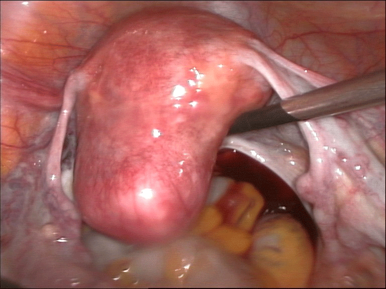 Gebärmutter vor der Hysterektomie