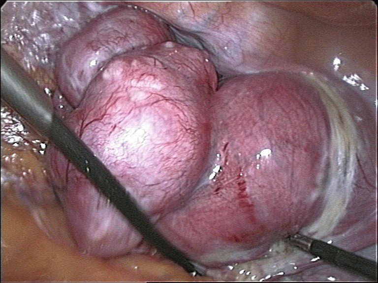 Transvaginale Extraktion des Uterus bei der Totalen laparoskopischen Hysterektomie