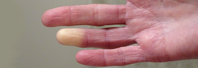 Beim Raynaud-Syndrom führen Vasospasmen zum Erblassen der Finger oder Zehen.