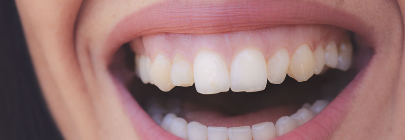 Gesundes Zahnfleisch scheint wichtig zur Vermeidung von Hypertonie zu sein.
