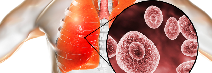 Pneumocystis jirovecii ist ein Erreger von Pneumonien.