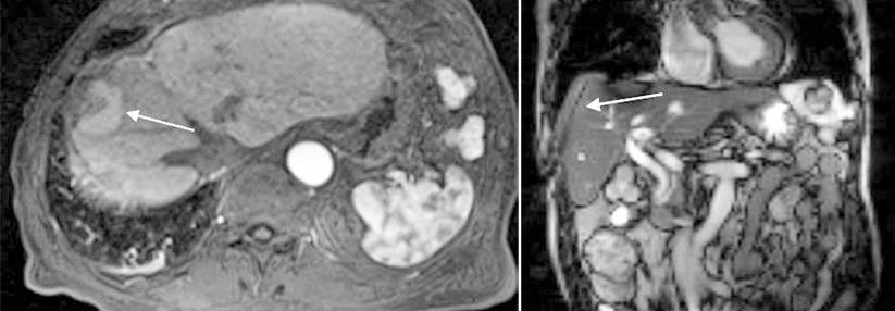 Kontrolle in der MRT nach erfolgreicher Mikrowellen­ablation. Der Tumor nimmt kein Kontrastmittel mehr auf und ist von einer großen Ablationszone (Pfeil) umgeben (links).
Exakte Positionierung der Ablationsantenne (Pfeil) in der MRT (rechts).