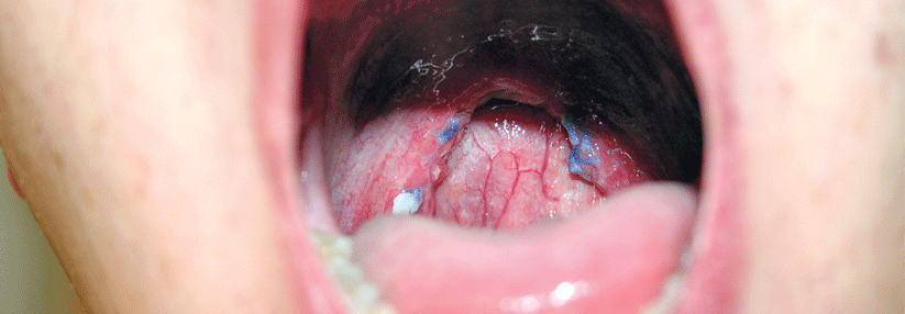 Dieser Patient hat sich einer Uvulopalatopharyngoplastik unterzogen.
