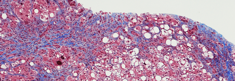 Eine chronische Hepatitis kann langfristig auch zu einer Leberzirrhose oder gar zu Karzinomen führen.