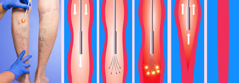 Krampfadern: Laserablation schneidet besser ab als OP und Sklerosierung Effektiv und dabei sogar kostengünstig: Mit dem Lichtschwert gegen Krampfadern.